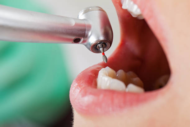 Best Emergency Dental Care for Broken or Chipped Teeth in Forest City, PA